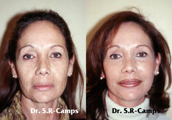 Lifting Facial: Cirugía y postoperatorio