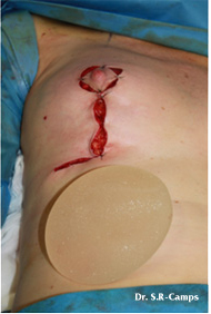 Intacto asignar anchura Mamoplastia en "L" y "Autoprotesis" por Explante