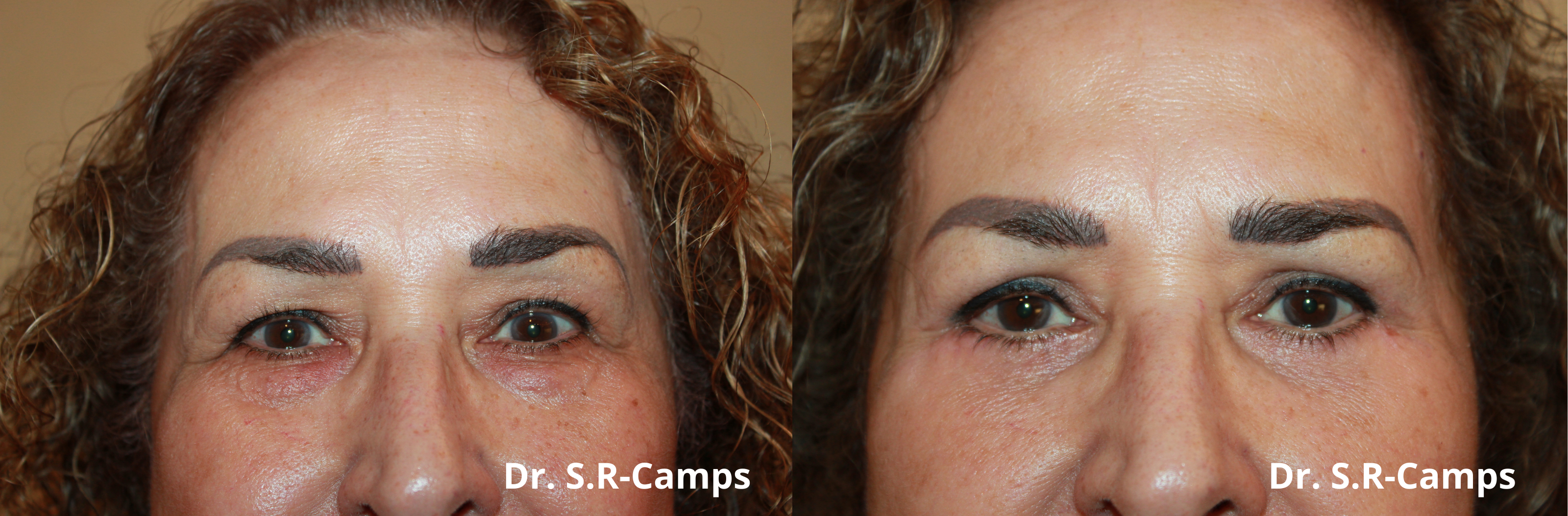 blefaroplastia antes y despues