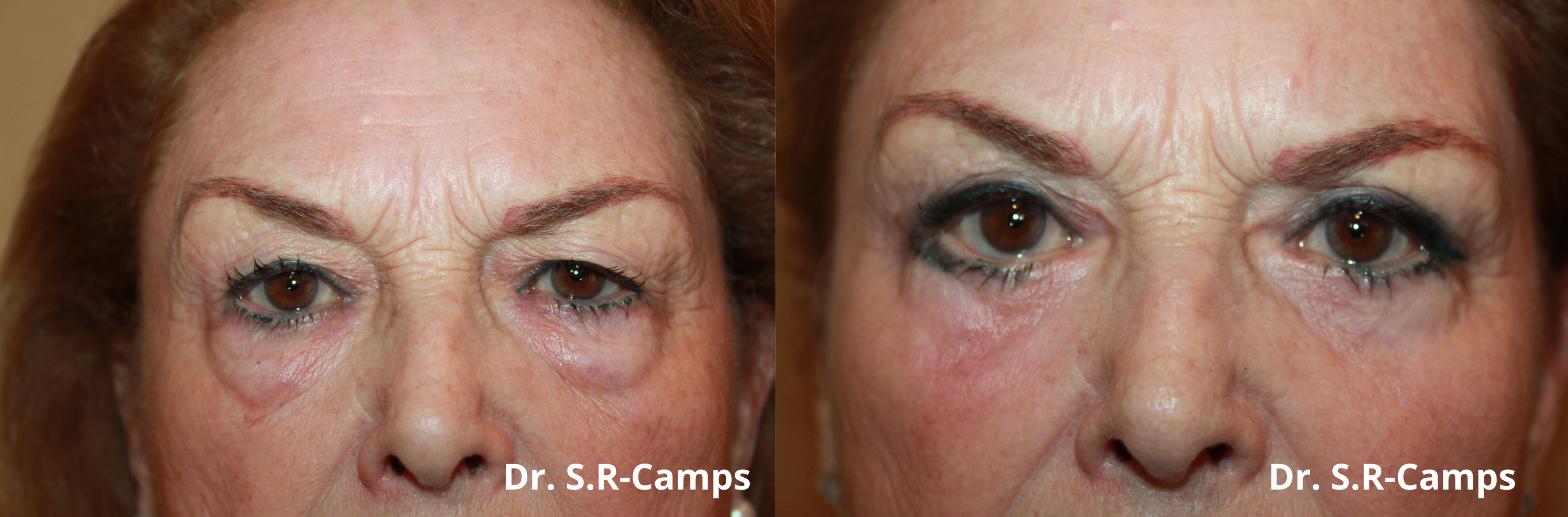 blefaroplastia operacion antes despues
