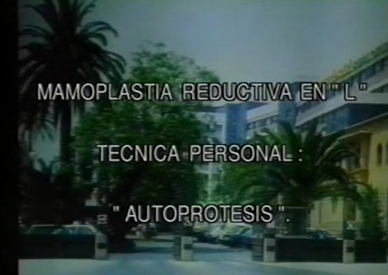 Mamoplastia de reducción