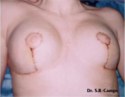 Mamoplastia de reducción: beneficios físicos y psicológicos