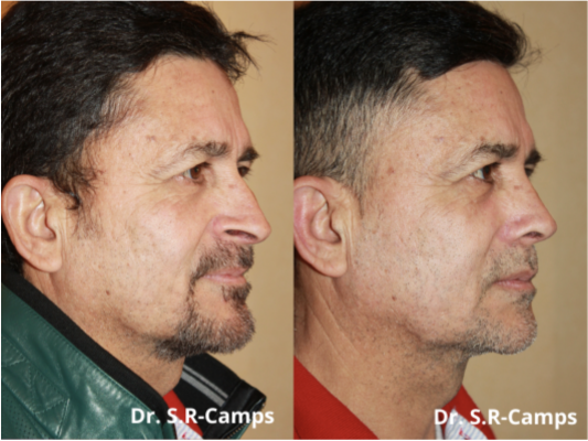 Rinoplastia: diferencias entre rinoplastia tradicional y ultrasónica