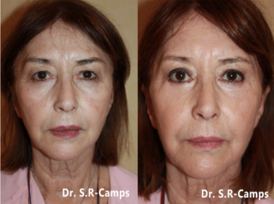 Blefaroplastia: cómo rejuvenecer tu mirada sin cambiar tu expresión