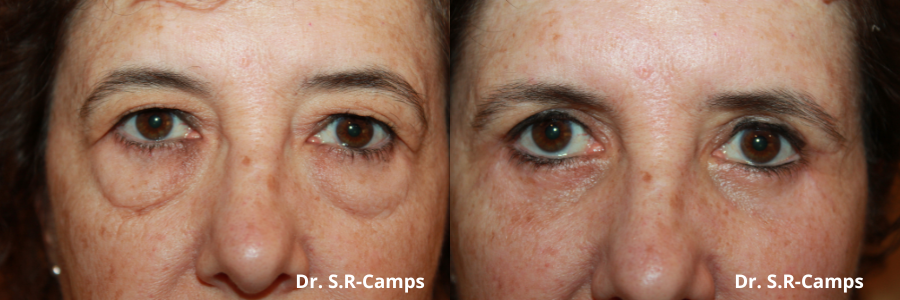 BLEFAROPLASTIA