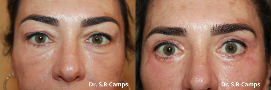 BLEFAROPLASTIA