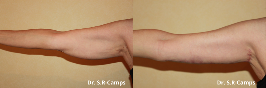 Antes y Después Braquioplastia