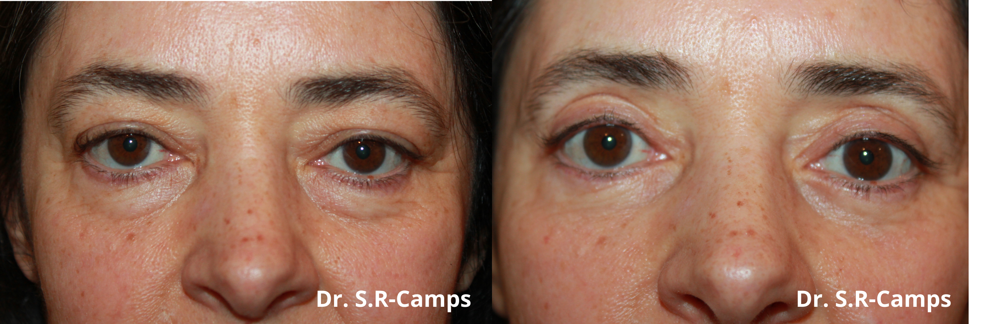 Blefaroplastia antes y después