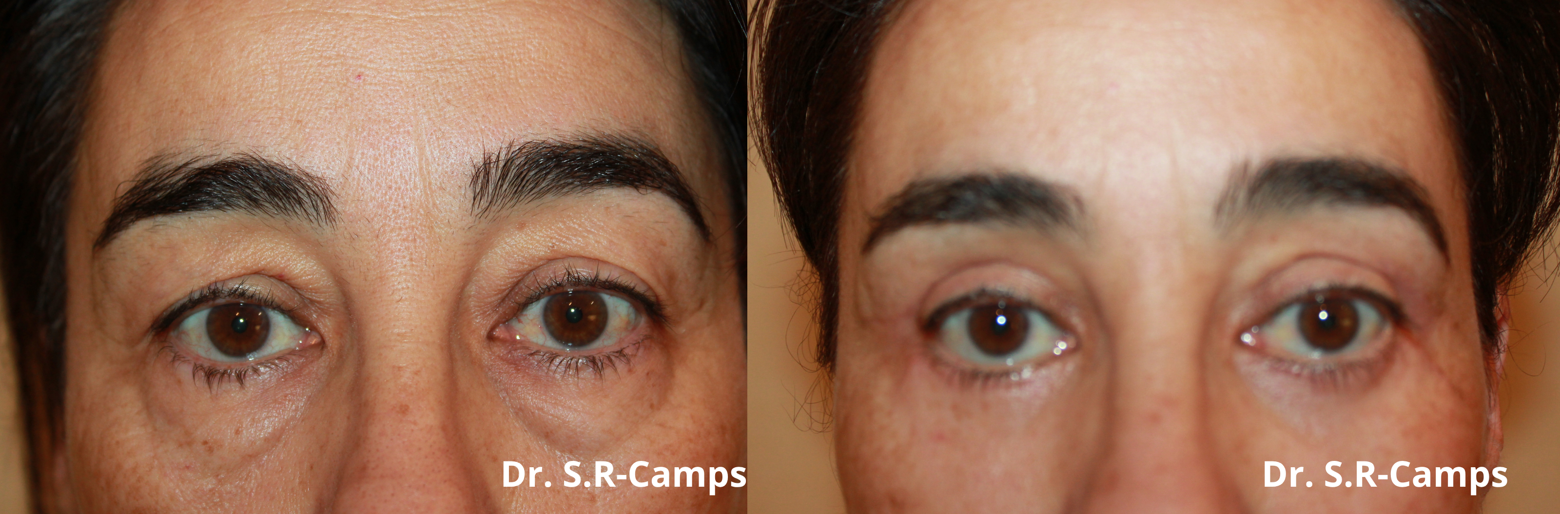 blefaroplastia antes y después