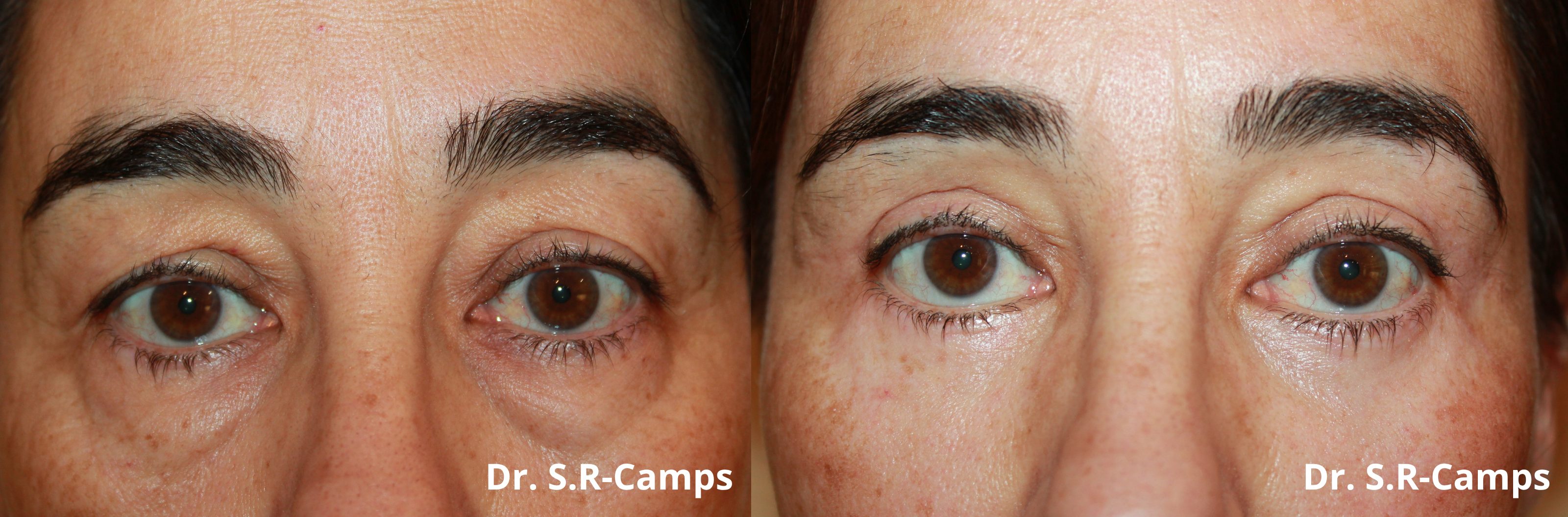 Blefaroplastia