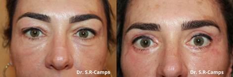 BLEFAROPLASTIA VALENCIA