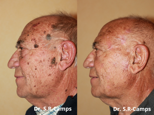 laser resurfacing