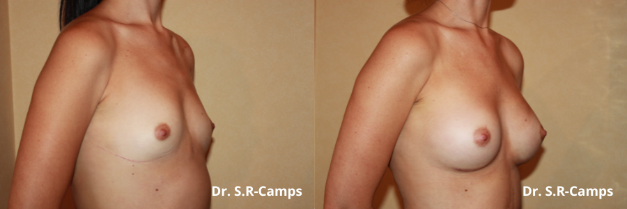 Mamoplastia Valencia