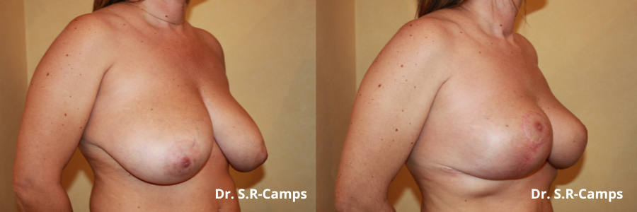 Mamoplastia