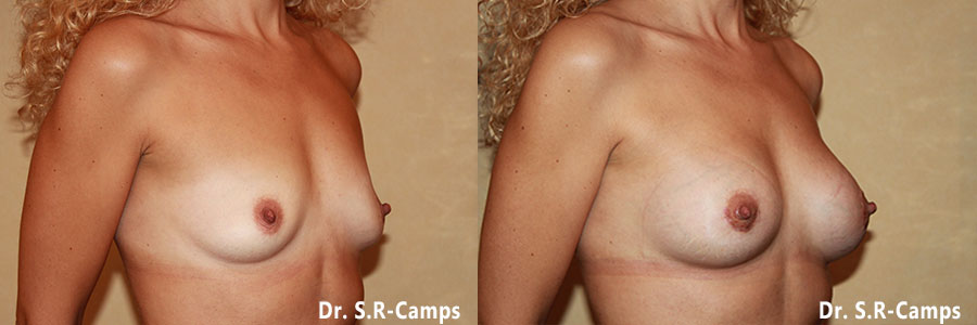 mamoplastia antes y despues