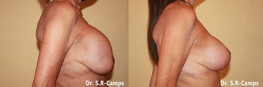mamoplastia antes y despues