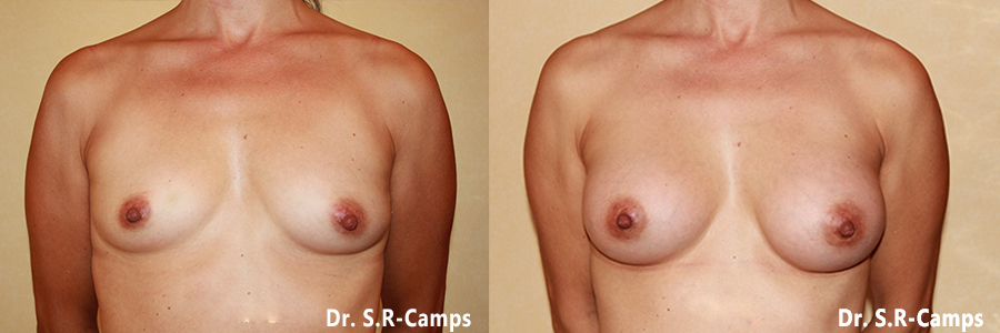 mamoplastia antes y despues rodriguez camps