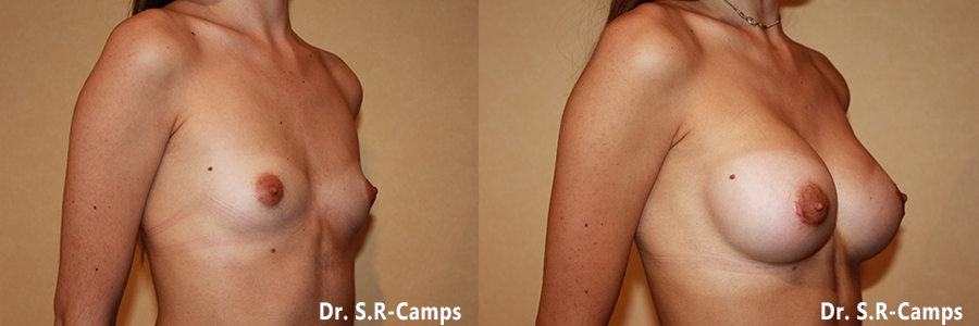 mamoplastia antes y despues rodriguez camps