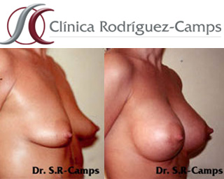 Mamoplastia de aumento antes y después|Clínica Rodríguez-Camps