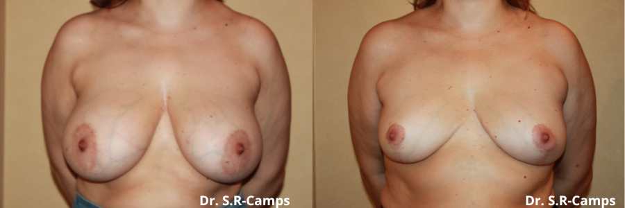 mamoplastia de reduccion antes despues