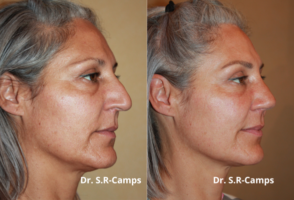 Rinoplastia Antes y Después