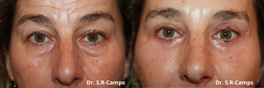 Blefaroplastia Valencia: Blefaroplastia antes y después
