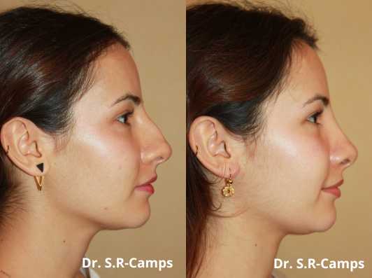 operacion de rinoplastia antes y despues