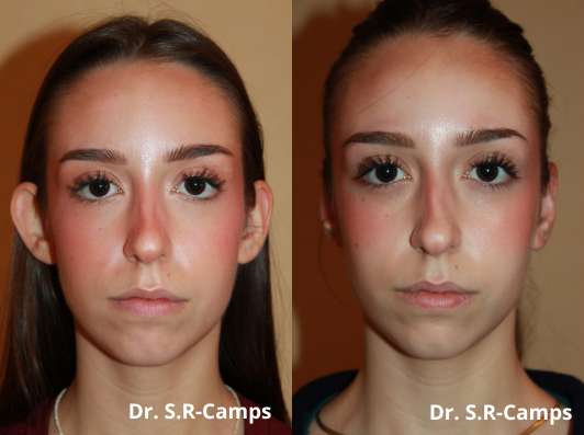 operacion otoplastia antes y despues