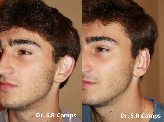 otoplastia orejas antes y despues