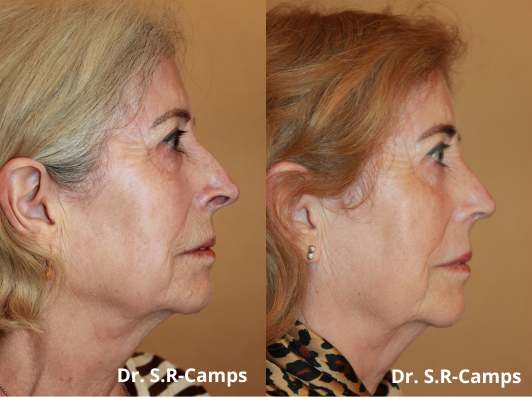 rinoplastia antes despues operacion nariz