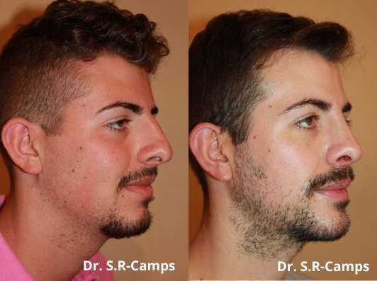 rinoplastia y perfiloplastia antes despues