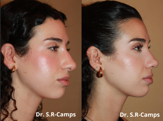 RinoplastiaLifting Facial