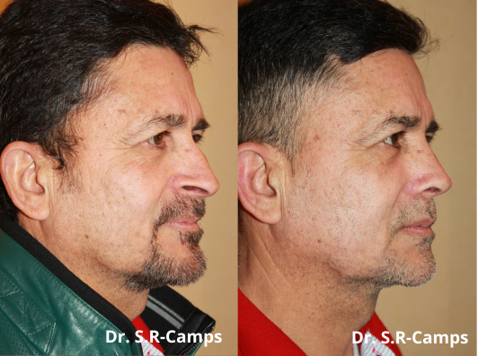 Rinoplastia Lifting Facial Valencia