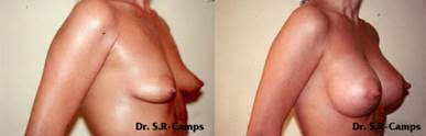 mamoplastia valencia